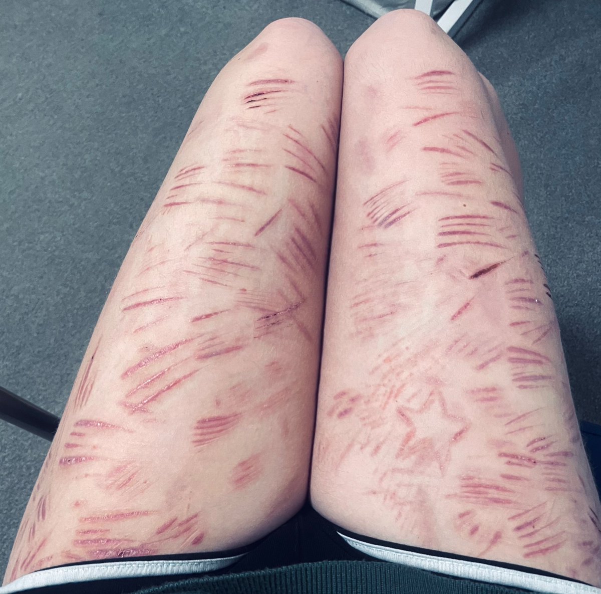 ms_hxpelessALT's tweet photo. Scar check ALMOST ALL FULLY HEALEDDDD #shtwt #shedtwt shush I know my thighs are fat https://t.co/MVG3XVXitf