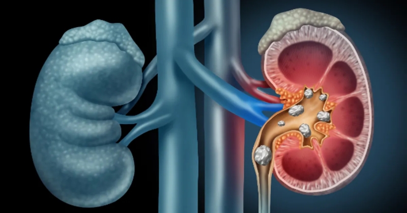 ثورة طبية.. الذكاء الاصطناعي يكشف سرطان الكلى في وقت قياسي 