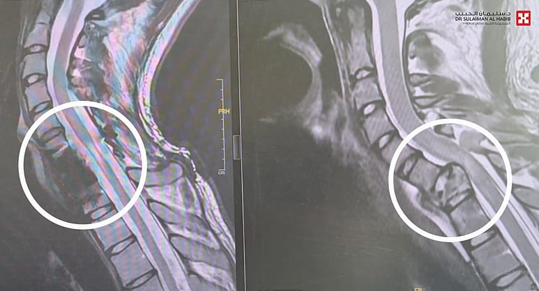 مستشفى الدكتور سليمان الحبيب بالقصيم ينقذ شاب تعرض لحادث مروري من الشلل المحتم بجراحتين معقدتين 