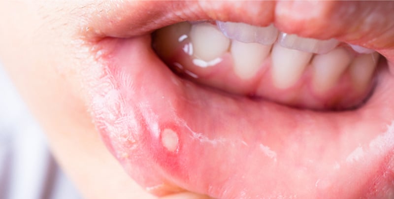 قروح الفم: أسباب شائعة وتنبيهات صحية. تقرحات مؤلمة تؤثر على الأكل والكلام وجودة الحياة. أكثر شيوعًا لدى النساء والأطفال ومن لديهم تاريخ وراثي. نقص B12 والحديد والزنك قد يزيد تكرارها. أحيانًا مؤشر لأمراض مناعية أو هضمية 