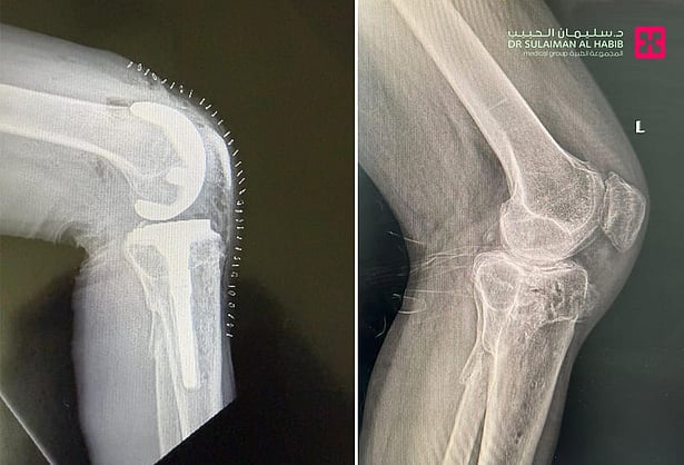 مجمع الدكتور سليمان الحبيب بالعليا يجري عملية استبدال للركبة باستخدام مفصل مطبوع بالتقنية ثلاثية الأبعاد 