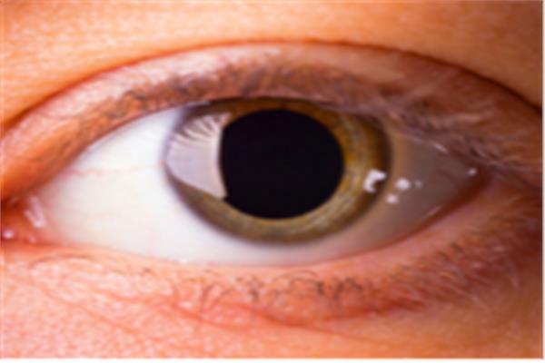 اختبار حدقة العين يكشف المصابين بانعدام القدرة على التخيل 