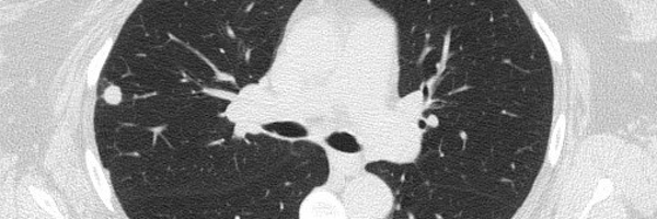 lung_ca_screen Profile Banner