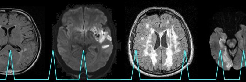 Neuro-AFib Coalition banner