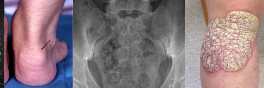 Leeds Spondyloarthritis Team banner