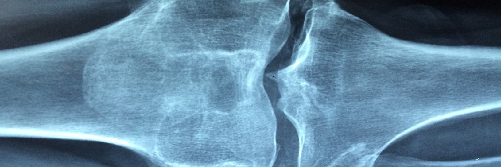 Arthritis Disorders banner