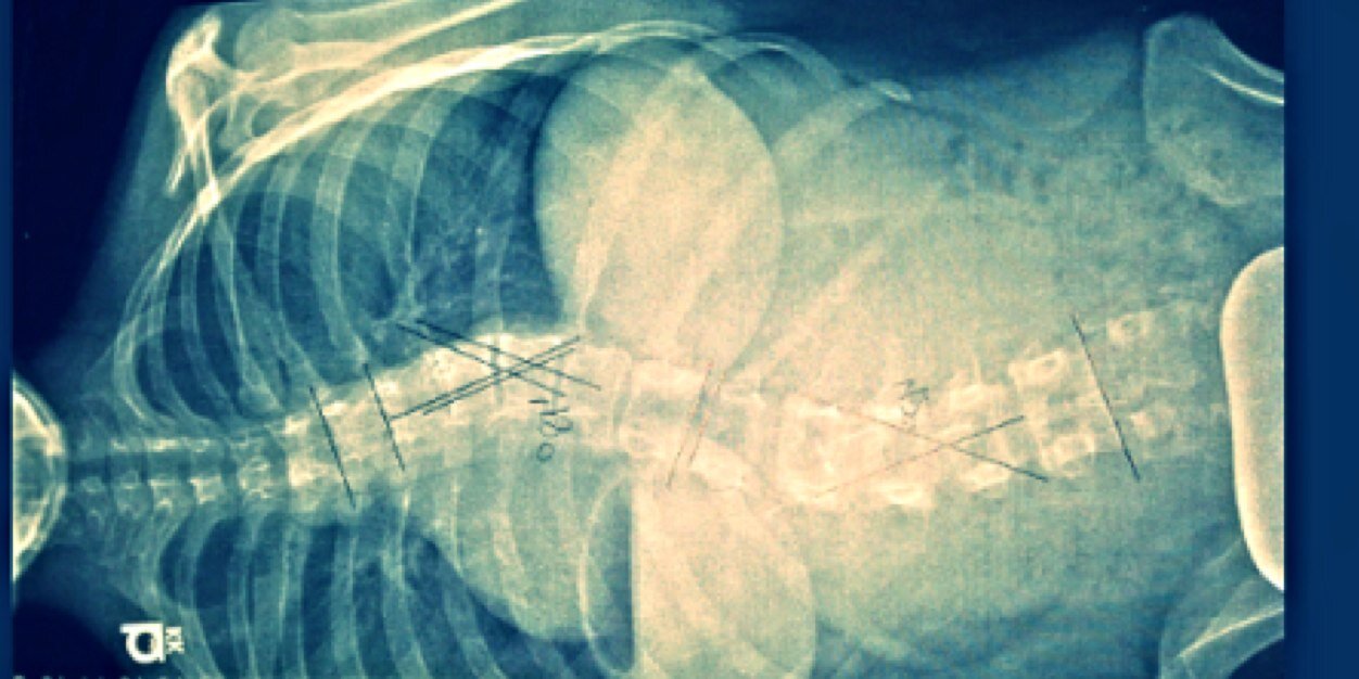 Scoliosis Girl (@ScoliosisSucks) / Posts / X