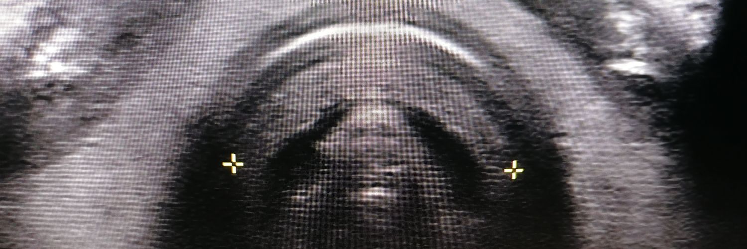 Trache Size Project - @HelenNewmanSLT banner