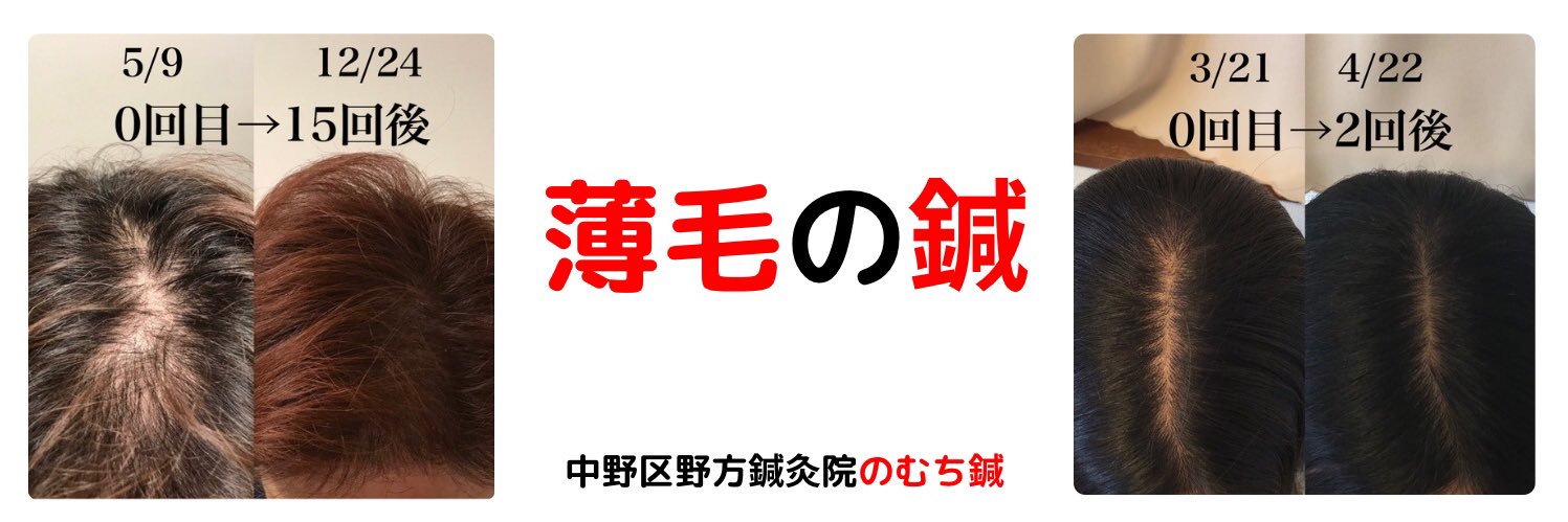 【中野区野方】薄毛の鍼|のむち banner