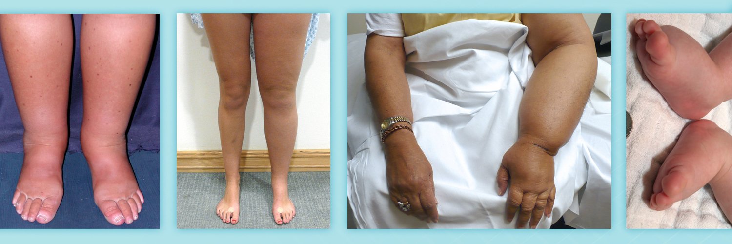 Lymphoedema Ireland banner