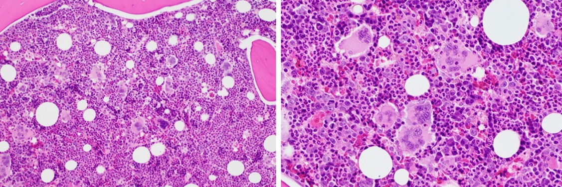 Hematology Media Center (HMC)💡 banner