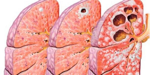 Mycobac Tuberculosis banner