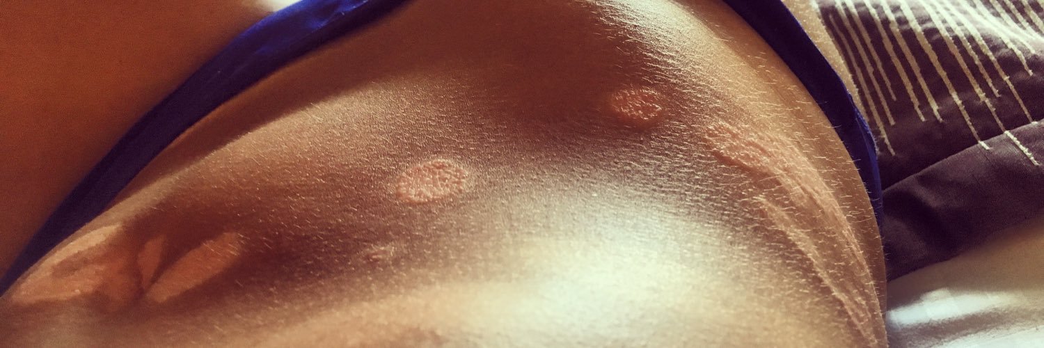 Fix my psoriasis banner