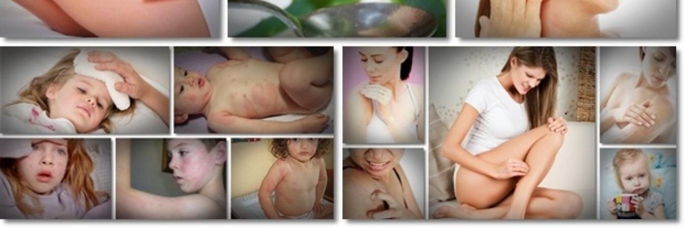 Urticaria_Cure's profile banner image
