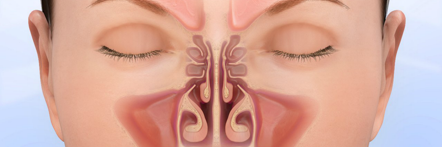 Нижняя подслизистая вазотомия. Вазотомия носовых раковин. Операция на нос вазотомия.
