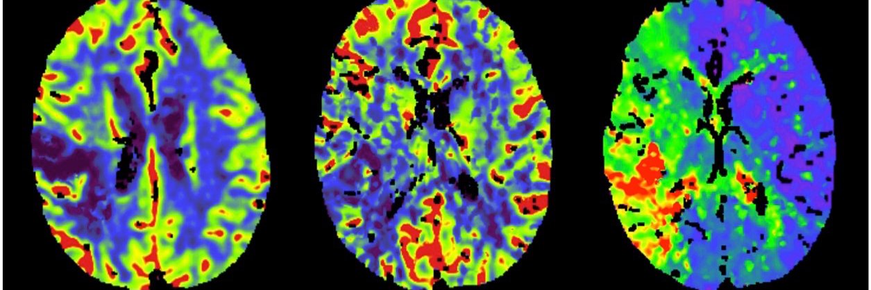 Cambridge Stroke banner