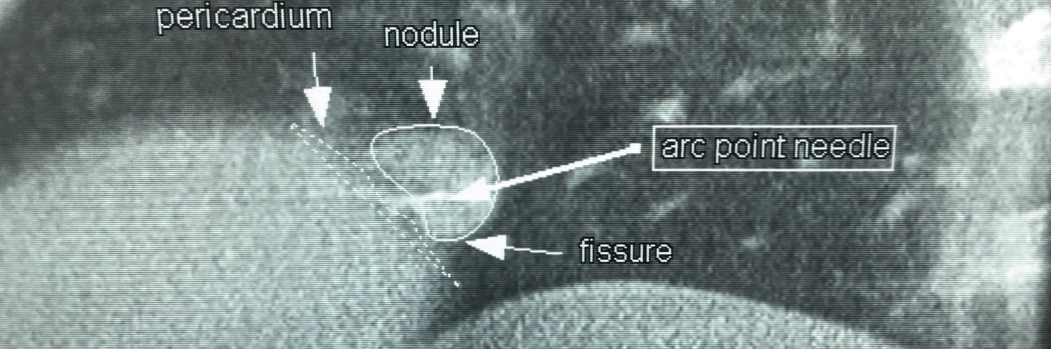 Bhadra & Condra CBCT Bronchoscopy banner