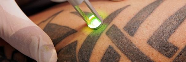 Laser Tattoo Removal banner