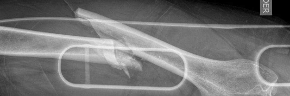 Harry Potter y el fémur roto banner