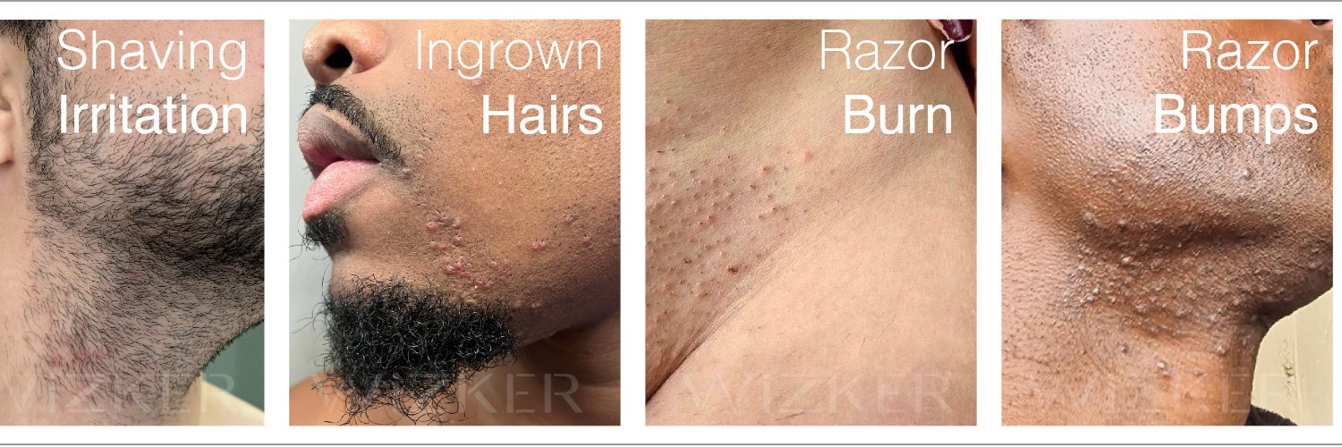 a WIZKER brush prevents bumps (@wizkerskin) / Posts / X