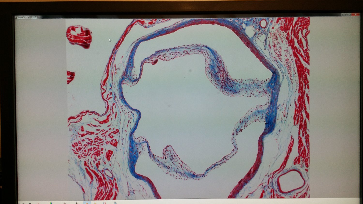 Bicuspid  Foundation banner