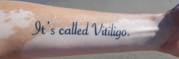 StepUp4Vitiligo Profile Banner