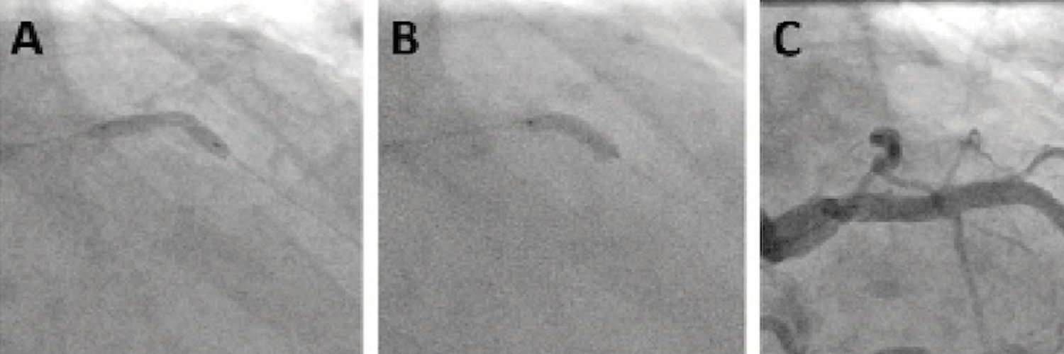Cath Lab Digest (CathLabDigest) / Twitter