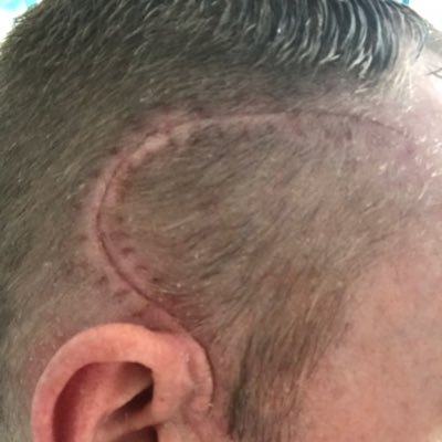 father to 3 kids, family man, engaged to be married, BCFC and boxing fan. Grade 4 glioblastoma brain cancer, 2 tumours removed, still keeping right on.