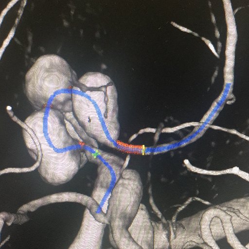 Interventional Neuroradiology. Minimally invasive treatments for the brain and spine. #withoutascalpel