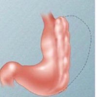 endosleeve 2018 كرمشةالمعدة (@endosleeve) 's Twitter Profile