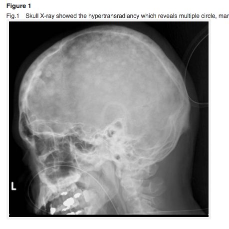 Information on chronic recurrent multifocal osteomyelitis (CRMO) and CNO from a patient advocate.