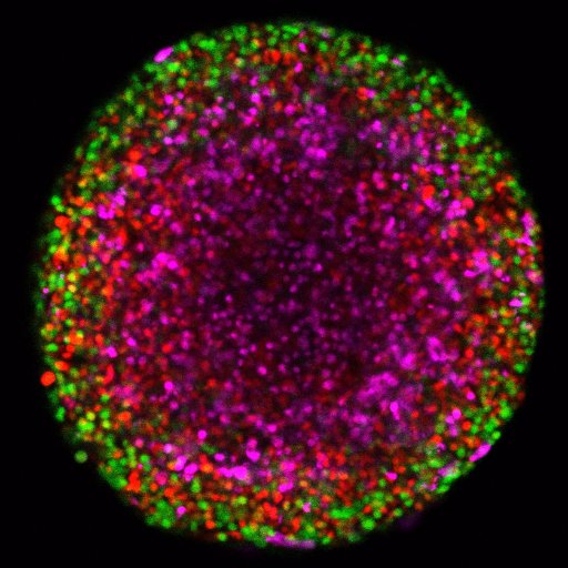 Understanding the biology of melanoma heterogeneity with a goal to improve therapies. #tumor_spheroids #microscopy #scitweets #FUCCI