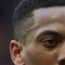 Anthony Martial's Forehead Vein