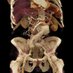 RLH & SBH Interventional Radiology (@barts_ir) Twitter profile photo RLH & SBH Interventional Radiology (@barts_ir) Twitter profile photo