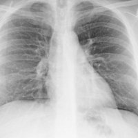 Bristol Centre for Lung Health (@bristollung) 's Twitter Profile