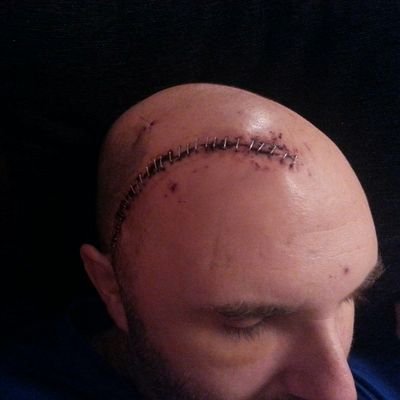 Stevens Johnsons Syndrome survivor. Epileptic Diabetic - now with removed amygdala and hippocampus. Biscuits for knees, should have been put down by now - WAWAW