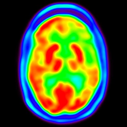 Grupo Investigación en Enfermedades Neurológicas #HospitalClinicoSanCarlos @IIS_IdISSC / #Alzheimer #aphasia #MultipleSclerosis #Parkinson #Migraine #ALS #COVID