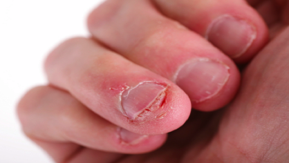 Feel like you'll never be able to stop biting your nails? You've done it for years and can't stop. Learn what you need to do in order to control your bad habit.