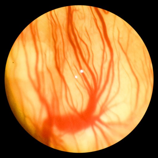 Vitreoretinal Surgeon, Director, Patient Services, Dr NSD Raju's Eye Hospital. Vyttila, Cochin, Kerala