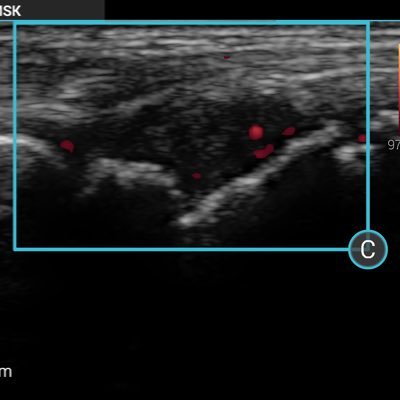 Rheum & GIM SpR- #POCUS fan and enthusiast- Working to raise awareness of bedside US in UK.. RTs