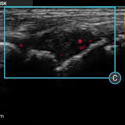 Rheum & GIM SpR- #POCUS fan and enthusiast- Working to raise awareness of bedside US in UK.. RTs 