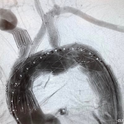 Uppsala Aortic Center Profile