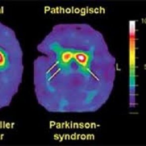 🎗IDIBAPS/HCPB Parkinson Disease Group Profile