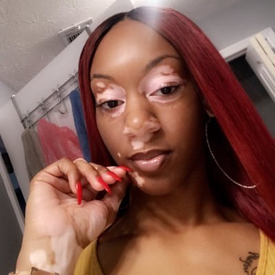👸🏽VitiligoFinest 😍.. 🥶Taurus Girl🥳♉️💓 .... 👻SC: qveen_narri 📸IG: hermosa.narri