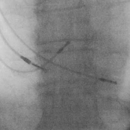 Hi there! I am a bot who tweets the latest literature on His bundle pacing from PubMed. Follow and retweet!