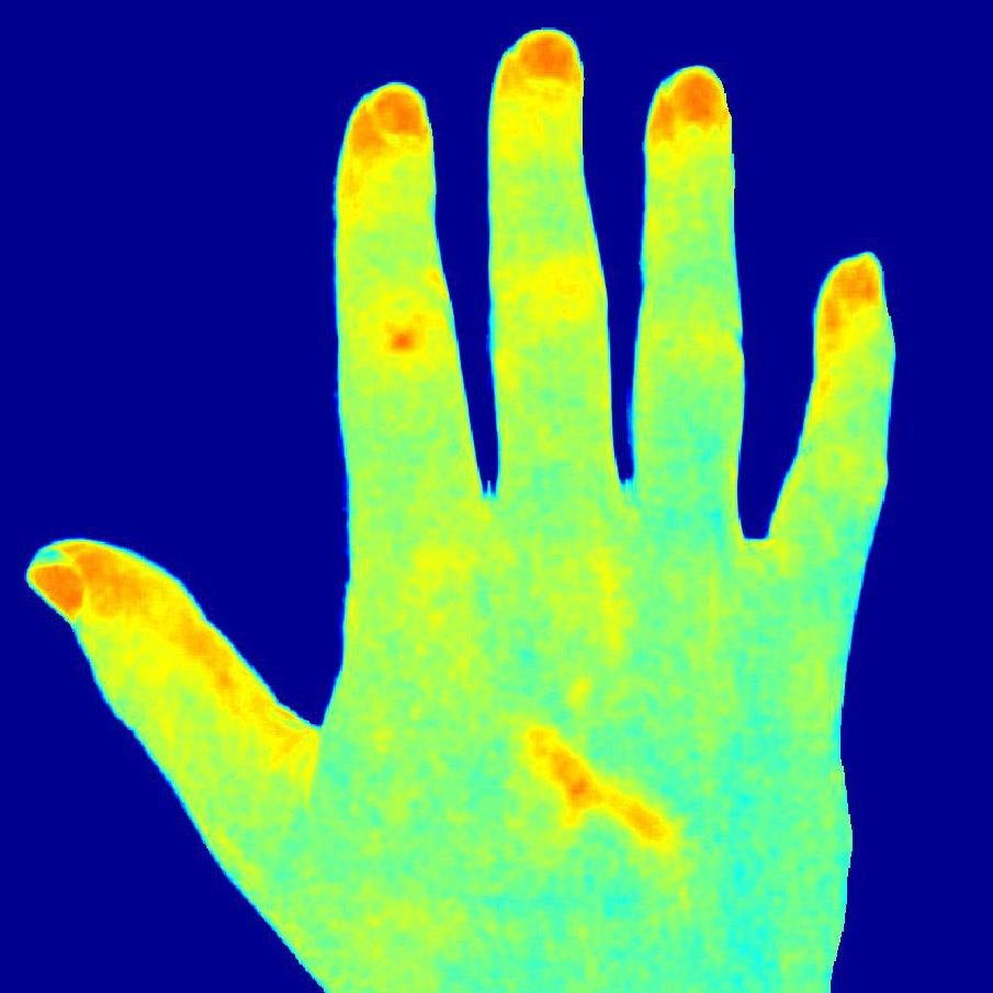 Scleroderma research at the University of Manchester & Salford Royal Hospital.
For nailfold capillaroscopy research from our group, check out @McrNCM