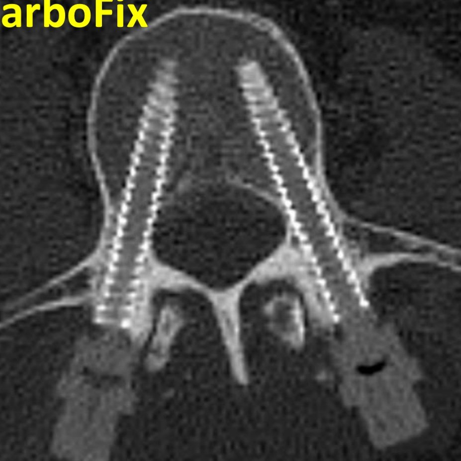 Director of Spinal Oncology, US Carbofix