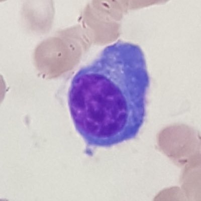 MyelomaUHL