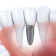 Odontólogo. Periodoncia e Implantes