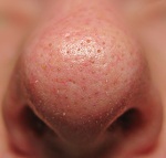 Celebrate those pimples, spots and zits here! The best zit pics every week get a free tube of Sudocrem Skin Care Cream.